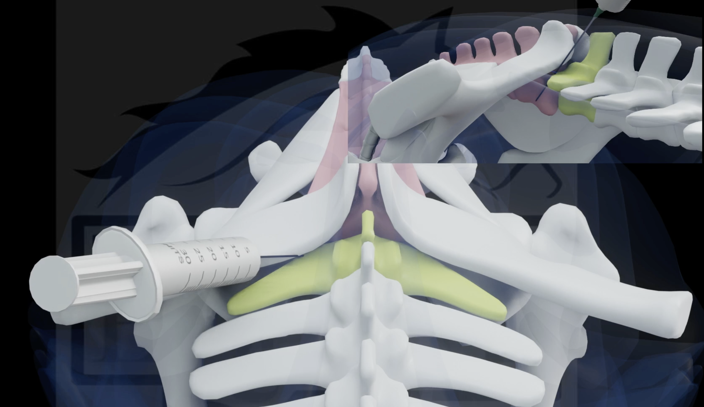 Sl Injection In Hand Post Treatment Care After Sacroiliac or Lumbar injections